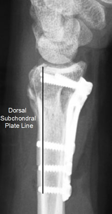 dorsal subchondral support line